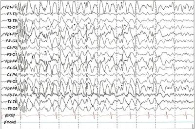 Transcranial Alternating Current Stimulation: A Potential Risk for Genetic Generalized Epilepsy Patients (Study Case)